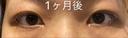 目頭切開 LUHO（ルホ）美容外科 DAY 30 サムネイル用
