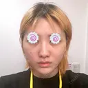 切開リフト 東京エビスクリニック AFTER サムネイル用