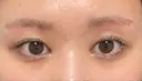 眼瞼下垂（切開） 水の森美容クリニック 福岡院 AFTER サムネイル用