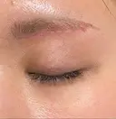 眼瞼下垂（切開） 水の森美容クリニック 福岡院 DAY 77 サムネイル用