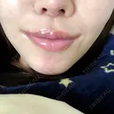 人中短縮 / 口唇縮小術 / 口角挙上 HB整形外科 DAY 23 サムネイル用