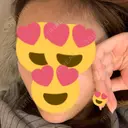 バッカルファット除去 / 脂肪吸引（顔） / 額を丸く / ヒアルロン酸注入（あご） / ボトックス（エラ・小顔） / ヒアルロン酸注入（額） エートップ美容整形外科 DAY 22 サムネイル用