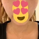 バッカルファット除去 / 脂肪吸引（顔） / 額を丸く / ヒアルロン酸注入（あご） / ボトックス（エラ・小顔） / ヒアルロン酸注入（額） エートップ美容整形外科 DAY 22 サムネイル用