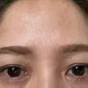 ヒアルロン酸注入（涙袋） / ボトックス（額） 渋谷美容外科クリニック 渋谷院 AFTER サムネイル用