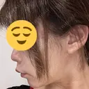 ボトックス（エラ・小顔） ルラ美容クリニック 大宮院 / ルラスキンクリニック 大宮院 DAY 18 サムネイル用