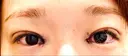 目頭切開 / 自然癒着法 / 眼瞼下垂（非切開） LUHO（ルホ）美容外科 DAY 0 サムネイル用