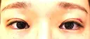 目頭切開 / 自然癒着法 / 眼瞼下垂（非切開） LUHO（ルホ）美容外科 DAY 0 サムネイル用