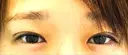 目頭切開 / 自然癒着法 / 眼瞼下垂（非切開） LUHO（ルホ）美容外科 DAY 0 サムネイル用