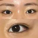 目頭切開 湘南美容クリニック 大阪心斎橋院 AFTER サムネイル用