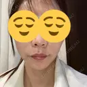 ボトックス（エラ・小顔） ルラ美容クリニック 大宮院 / ルラスキンクリニック 大宮院 AFTER サムネイル用