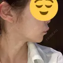 ボトックス（エラ・小顔） ルラ美容クリニック 大宮院 / ルラスキンクリニック 大宮院 DAY 19 サムネイル用