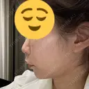 ボトックス（エラ・小顔） ルラ美容クリニック 大宮院 / ルラスキンクリニック 大宮院 DAY 19 サムネイル用