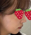 鼻尖形成（切開） / 軟骨移植 / 鼻尖縮小 / GLP-1ダイエット 東京シンデレラ美容外科 新宿院 DAY 15 サムネイル用