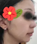 ヒアルロン酸注入（あご） / シワ取りボトックス ブルームクリニック（BLOOM CLINIC） AFTER サムネイル用