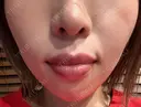 ボトックス（エラ・小顔） / ボトックス（口角） ブルームクリニック（BLOOM CLINIC） DAY 17 サムネイル用