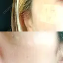 ルビーレーザー S-Laboクリニック 渋谷院 DAY 1 サムネイル用