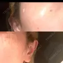 ルビーレーザー S-Laboクリニック 渋谷院 DAY 1 サムネイル用