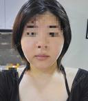 糸リフト / 脂肪吸引（顔） / あご下筋肉縛り / 脂肪注入（輪郭） セギム美容整形外科 DAY 3 サムネイル用
