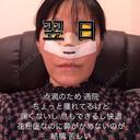 鼻尖形成（切開） / 鼻中隔延長（切開） / 軟骨移植 WOM CLINIC GINZA （ワム クリニック ギンザ） DAY 1 サムネイル用