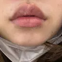 ヒアルロン酸注入（唇） シェリークリニック 新宿本院 AFTER サムネイル用