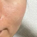 ニードルRF（ポテンツァなど） 美容皮膚科エルムクリニック 大阪院 AFTER サムネイル用