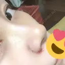 小鼻縮小（切開） / 鼻尖形成（非切開） / その他（鼻） CLINIC W DAY 4 サムネイル用