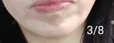 ボトックス（あご） 湘南美容クリニック 宇都宮院 DAY 11 サムネイル用