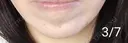 ボトックス（あご） 湘南美容クリニック 宇都宮院 DAY 10 サムネイル用