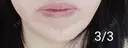 ボトックス（あご） 湘南美容クリニック 宇都宮院 DAY 6 サムネイル用