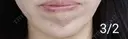ボトックス（あご） 湘南美容クリニック 宇都宮院 DAY 5 サムネイル用