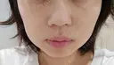 イオン導入 / 光治療（フォトフェイシャルなど） ルラ美容クリニック 大宮院 / ルラスキンクリニック 大宮院 AFTER サムネイル用