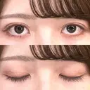 二重埋没 ルラ美容クリニック 渋谷本院 DAY 17 サムネイル用