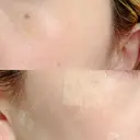 ルビーレーザー S-Laboクリニック 渋谷院 DAY 3 サムネイル用