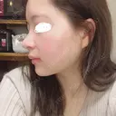 鼻尖形成（切開） / 鼻中隔延長（切開） / 小鼻縮小（切開） / 軟骨移植 / 鼻尖縮小 HANABI整形外科 DAY 11 サムネイル用