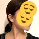 糸リフト / 脂肪吸引注射（顔） 湘南美容クリニック 吉祥寺院 DAY 58 サムネイル用