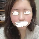 鼻尖形成（切開） / 鼻中隔延長（切開） / 小鼻縮小（切開） / 軟骨移植 / 鼻尖縮小 HANABI整形外科 DAY 11 サムネイル用