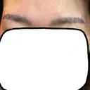 タトゥー除去 渋谷美容外科クリニック 池袋院 DAY 2 サムネイル用