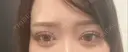 二重埋没 / 目頭切開 / 糸リフト / 脂肪吸引（顔） / ヒアルロン酸注入（涙袋） R Beauty CLINIC 名古屋院 DAY 30 サムネイル用