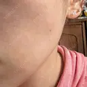 ボトックス（エラ・小顔） / ボトックス（肩） ルラ美容クリニック 横浜院 AFTER サムネイル用