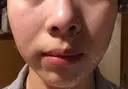 ガミースマイル手術 / 脂肪溶解注射（顔） 湘南美容クリニック 浜松院 AFTER サムネイル用
