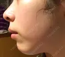 ガミースマイル手術 / 脂肪溶解注射（顔） 湘南美容クリニック 浜松院 DAY 7 サムネイル用