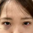 二重埋没 / クマ治療 R Beauty CLINIC 名古屋院 DAY 1 サムネイル用