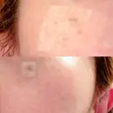 ルビーレーザー S-Laboクリニック 渋谷院 DAY 5 サムネイル用