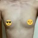 豊胸（脂肪注入） 銀座マイアミ美容外科 DAY 11 サムネイル用