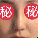 小鼻縮小（切開） / 軟骨移植 / 眉間プロテーゼ / 鼻尖形成（非切開） / 鼻柱下降・鼻唇角形成（猫手術） グローバルビューティークリニック 東京院 DAY 30 サムネイル用