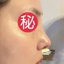 小鼻縮小（切開） / 軟骨移植 / 眉間プロテーゼ / 鼻尖形成（非切開） / 鼻柱下降・鼻唇角形成（猫手術） グローバルビューティークリニック 東京院 DAY 30 サムネイル用
