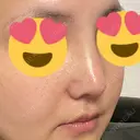小鼻縮小（切開） / 軟骨移植 / 眉間プロテーゼ / 鼻尖形成（非切開） / 鼻柱下降・鼻唇角形成（猫手術） グローバルビューティークリニック 東京院 DAY 10 サムネイル用