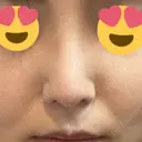 小鼻縮小（切開） / 軟骨移植 / 眉間プロテーゼ / 鼻尖形成（非切開） / 鼻柱下降・鼻唇角形成（猫手術） グローバルビューティークリニック 東京院 DAY 182 サムネイル用