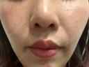 小鼻縮小（切開） / 人中短縮 / 鼻翼挙上 Otus Clinic 【オータスクリニック】 AFTER サムネイル用