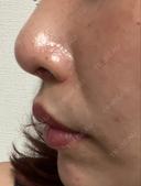 小鼻縮小（切開） / 人中短縮 / 鼻翼挙上 Otus Clinic 【オータスクリニック】 DAY 181 サムネイル用